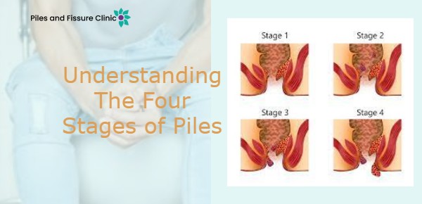 Understanding the Four Stages of Piles: A Comprehensive Guide