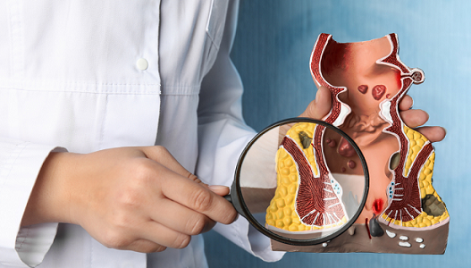 Best Piles Doctor in Noida