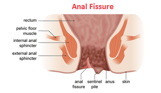 Fissure Treatment in Noida