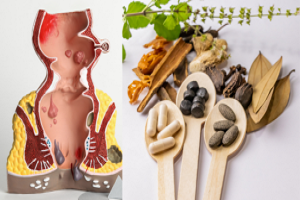 Ayurvedic Treatment for Piles